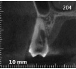 Riassorbimento esterno - Cone beam frontale